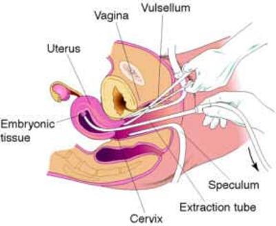 vacuum aspiration
