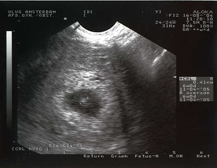 Ultrasound at 28 days