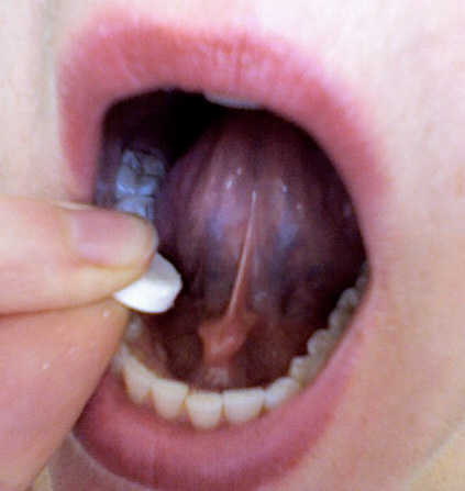 Sublingual cytotec, pastilla aborto