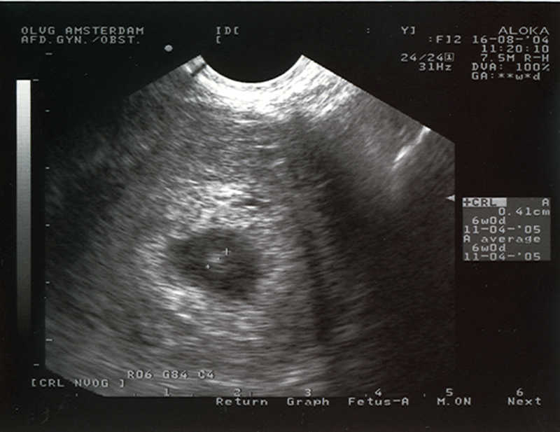 Ultrasound At 28 Days Women On Waves