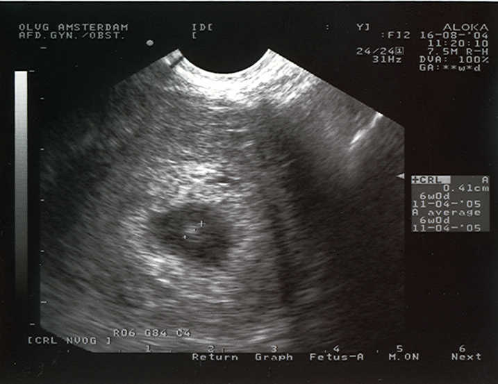 Ultrasound at 28 days – Women on Waves